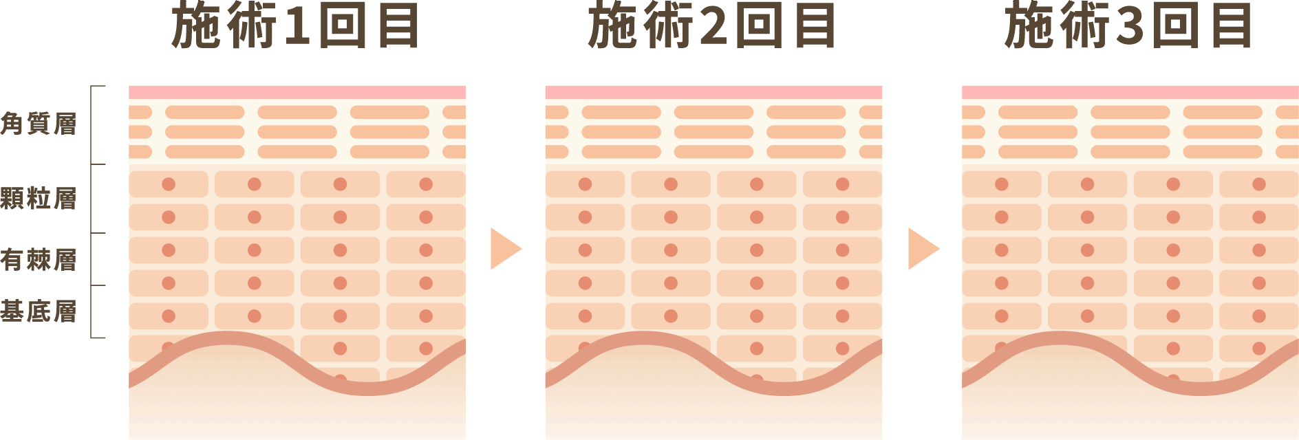 施術1回目から3回目の変化