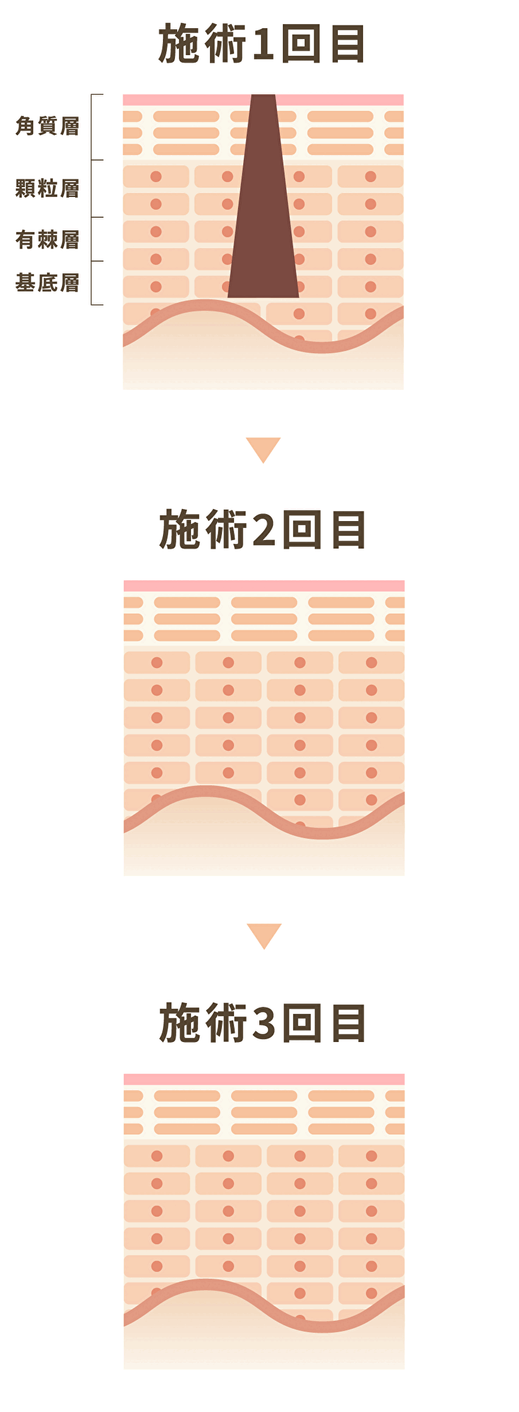 施術1回目から3回目の変化