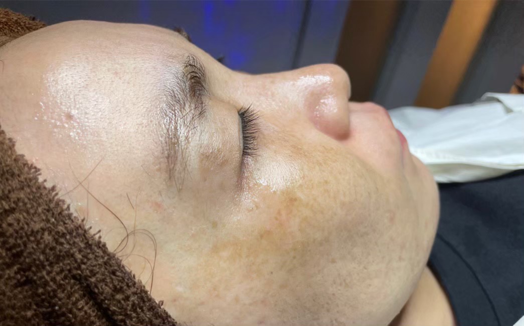 Kさん（30代 ・9回） Before