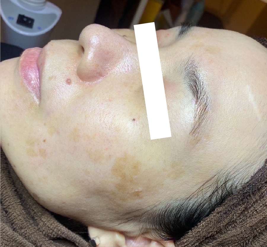 Oさん（40代 ・11回） Before