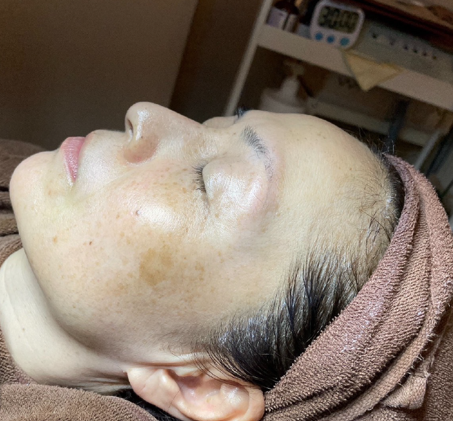 Yさん（50代 ・8回） Before