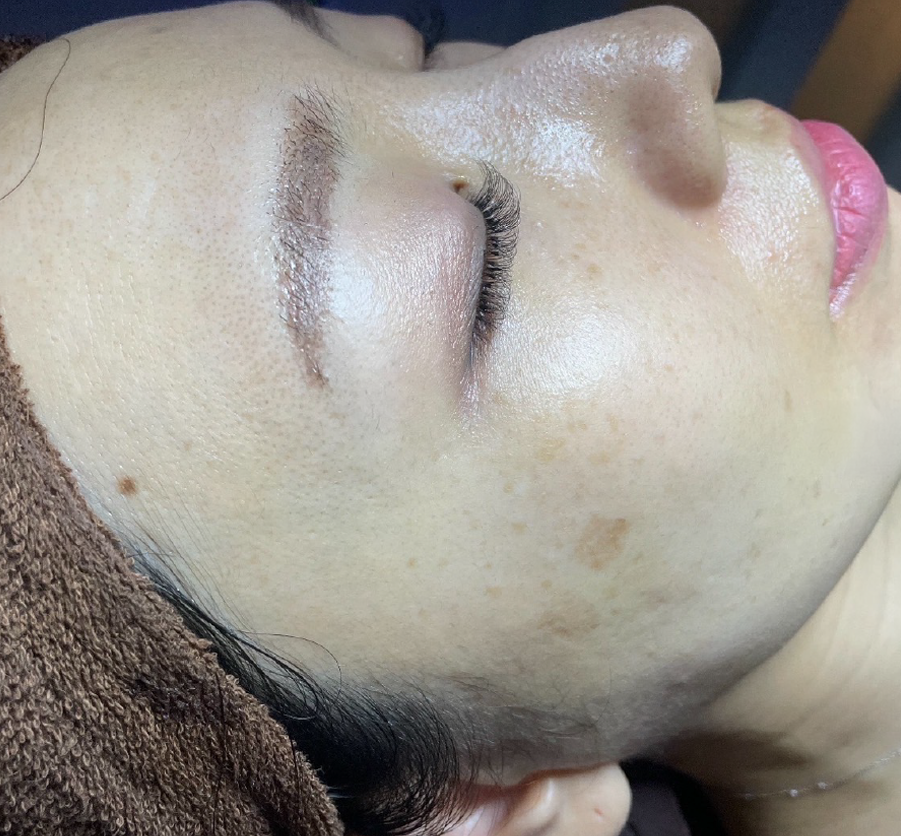 Kさん（30代 ・22回） Before